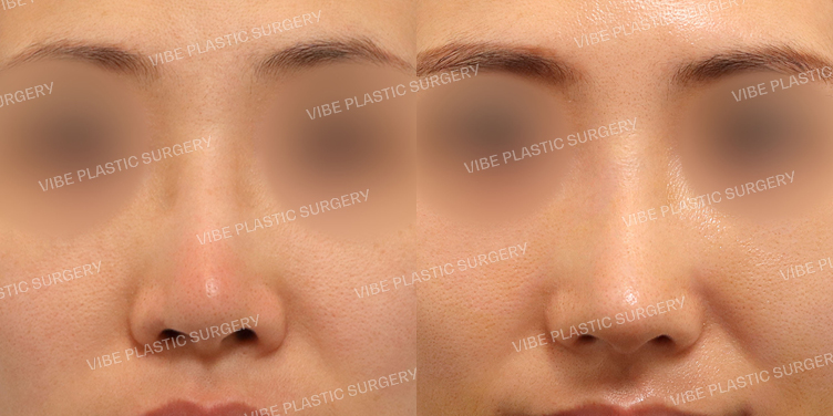 #3번째코재수술 #무보형물 #복코