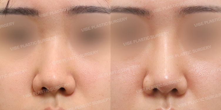 #복코 #매부리코 #휜코