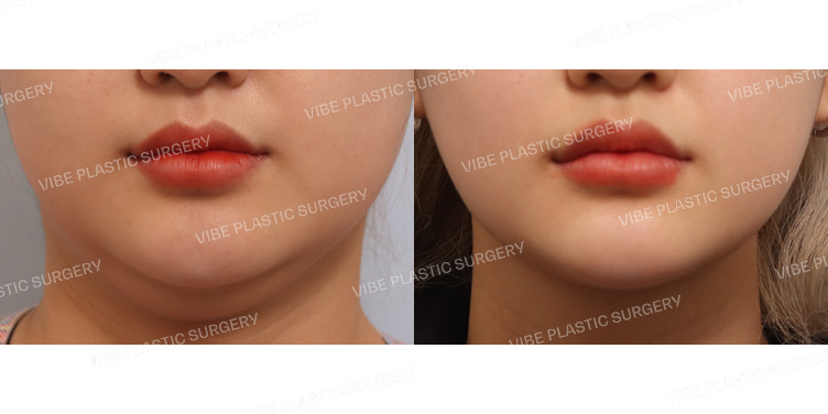 #리포사운드지방흡입(이중턱,턱라인)