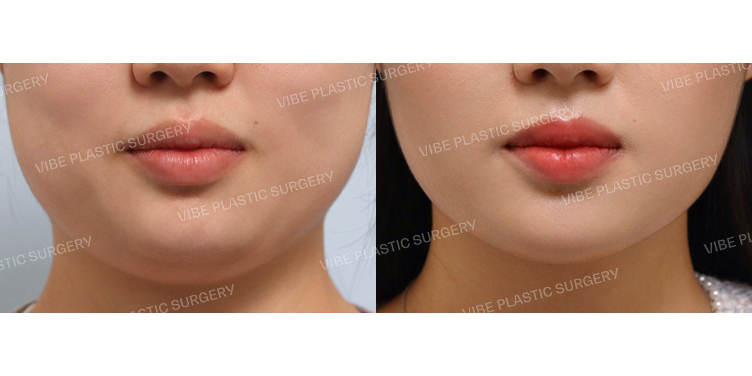 #초음파지방흡입(이중턱,턱라인) #사각턱보톡스