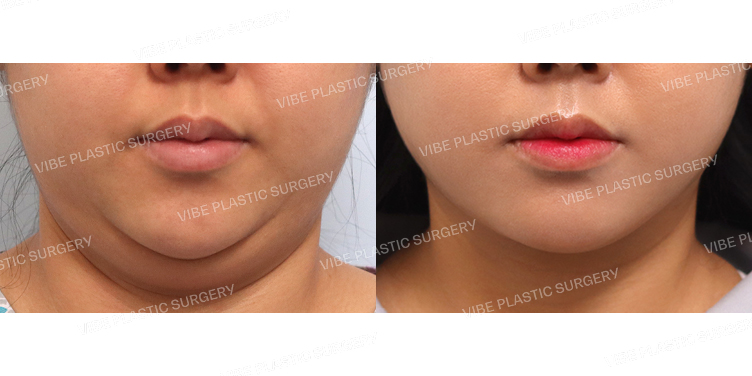 #초음파지방흡입(이중턱,턱라인)