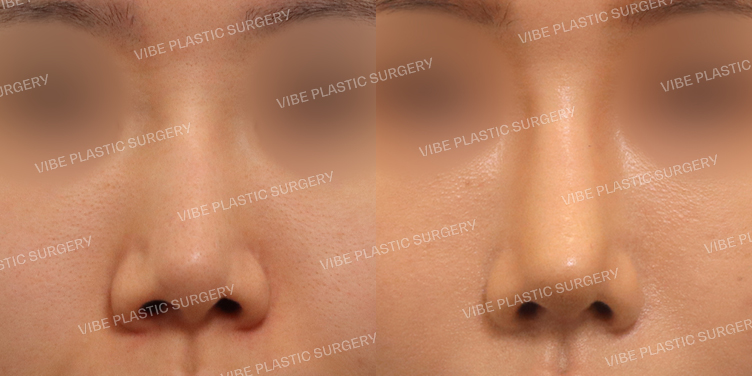 #자가늑연골 #재수술