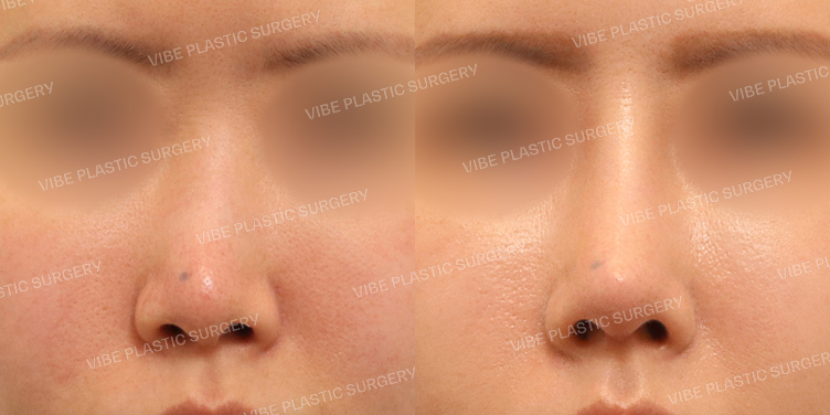 #휜코 #긴코 #기능코