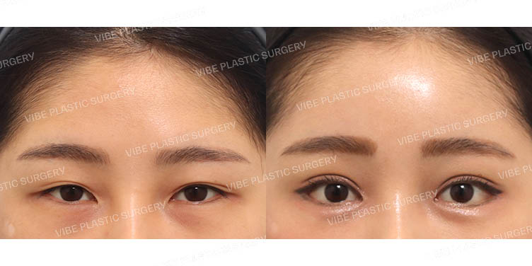 #내시경이마거상 #절개쌍꺼풀(재수술) #뒤트임 #밑트임