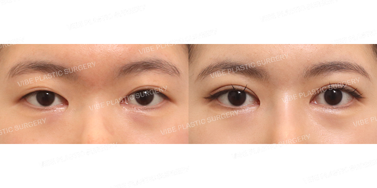 #절개쌍꺼풀(재수술)