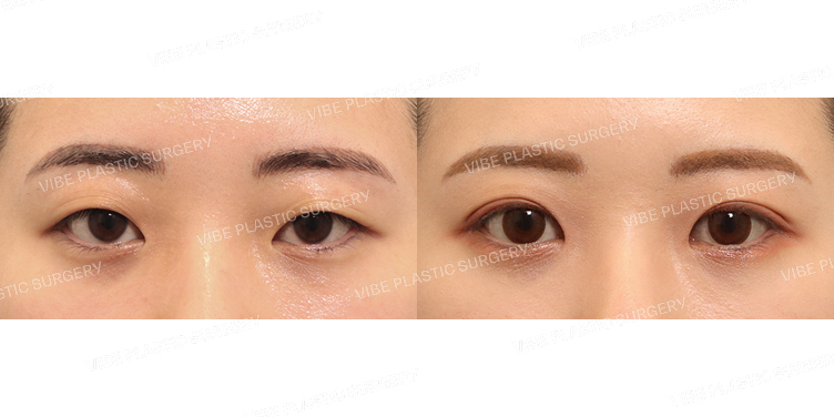 #자연유착 #앞트임