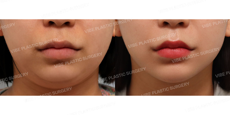 #초음파지방흡입(이중턱,턱라인) #턱끝필러 #사각턱보톡스