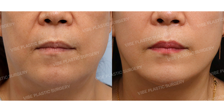 #절개안면거상 #목거상(이중턱근육묶기)