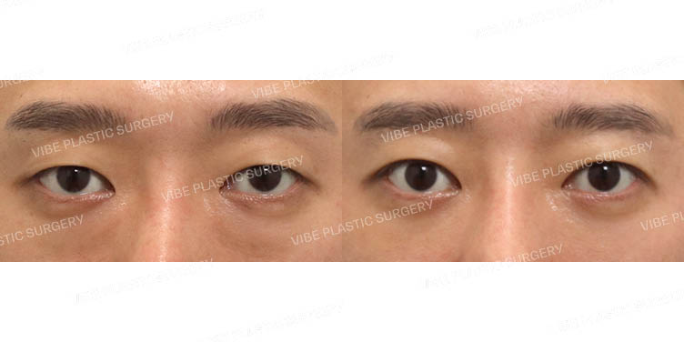 #무쌍눈매교정 #눈밑지방재배치