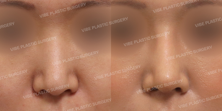 #매부리코 #긴코