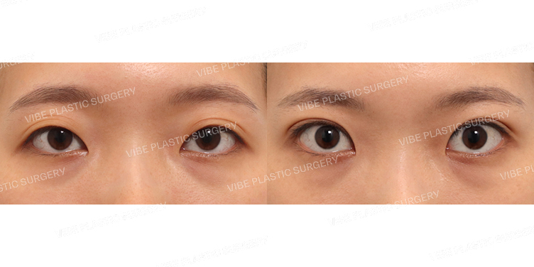 #비절개눈매교정