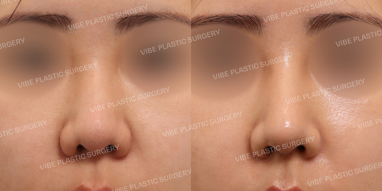 #복코 #매부리코