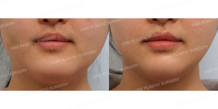 #초음파지방흡입(이중턱,턱라인)