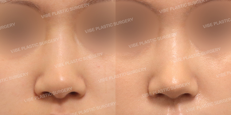 #무보형물 #비주교정 #매부리코