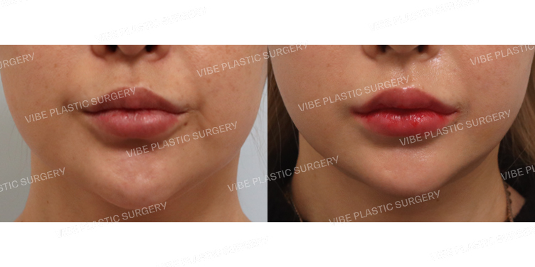 #실리프팅 #초음파지방흡입(이중턱,턱라인)