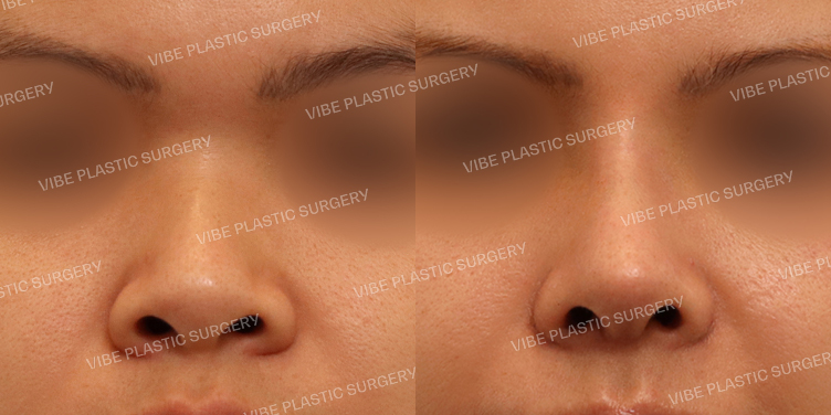 #낮은코 #복코 #콧볼축소