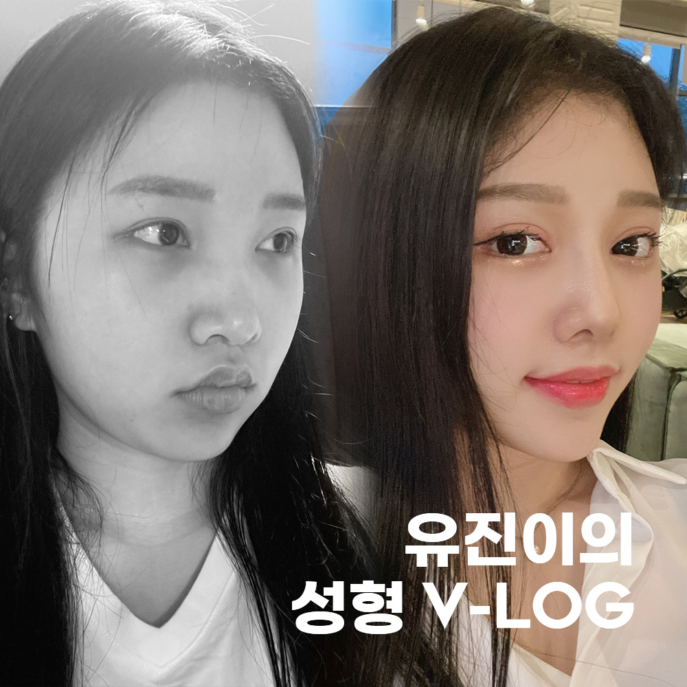 유진이의 성형 V-LOG