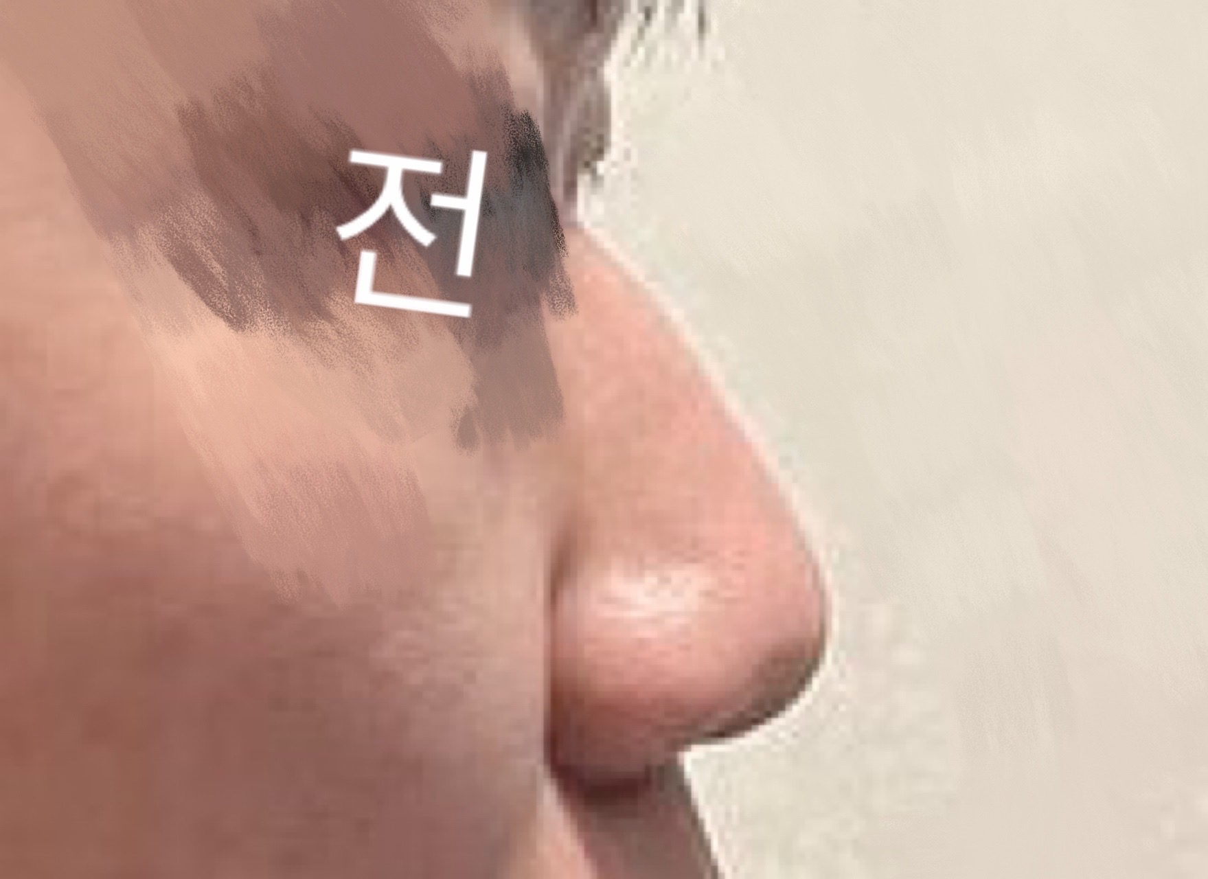 수술전_1_.jpg