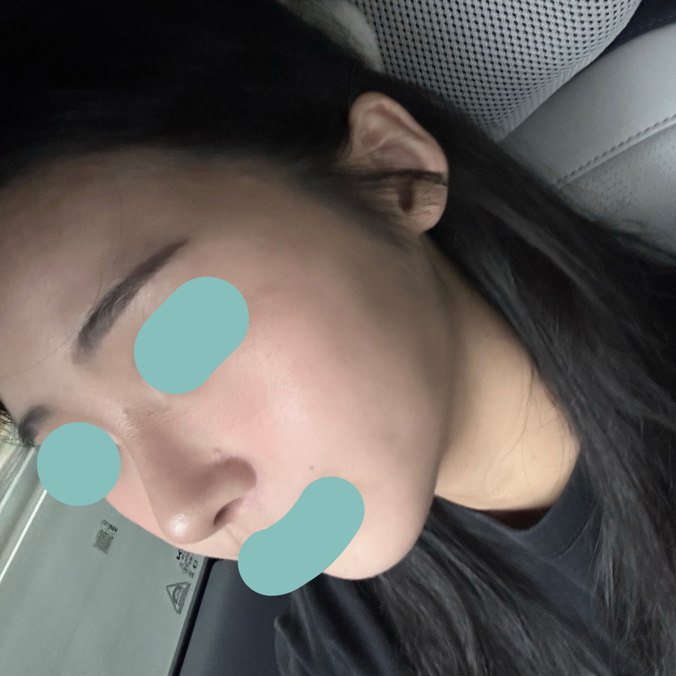 복코성형 4개월차입니다!