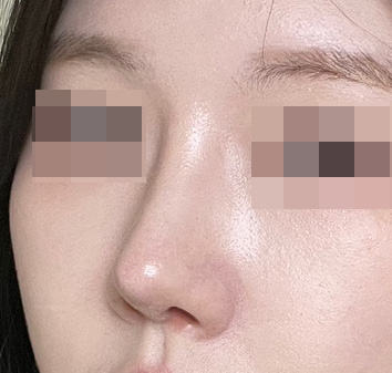 코수술받고 자신감 업!