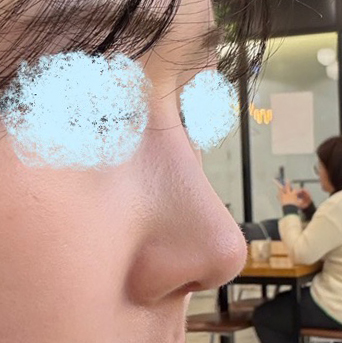 바이브에서 수술하길 잘했다고 생각중~