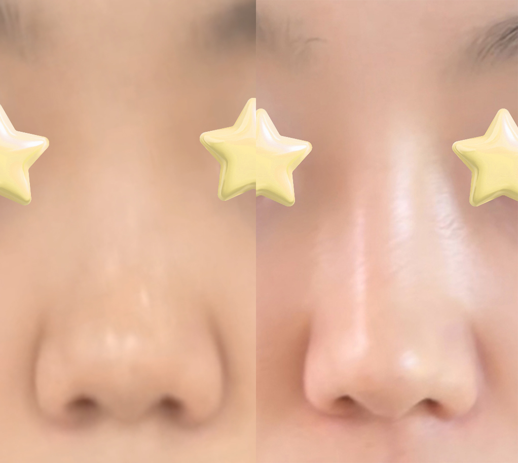 바이브 코성형 최고최고