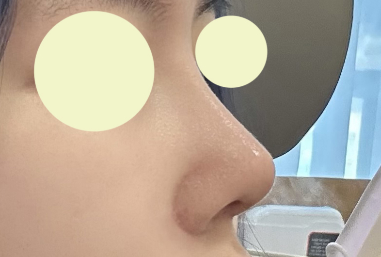 코 자연스럽게 잘됐어요 ㅎㅎ