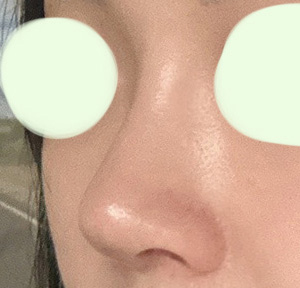 첫코수술 너무 잘됐어용