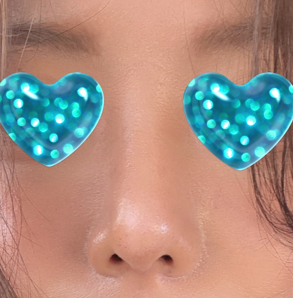 코성형은 바이브 적극추천드립니닷