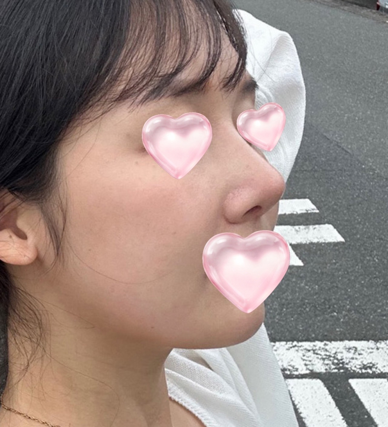 무보형물 코성형 3개월차 지나가요