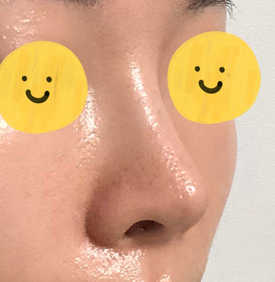 코3번째수술 바이브에서 성공해써용