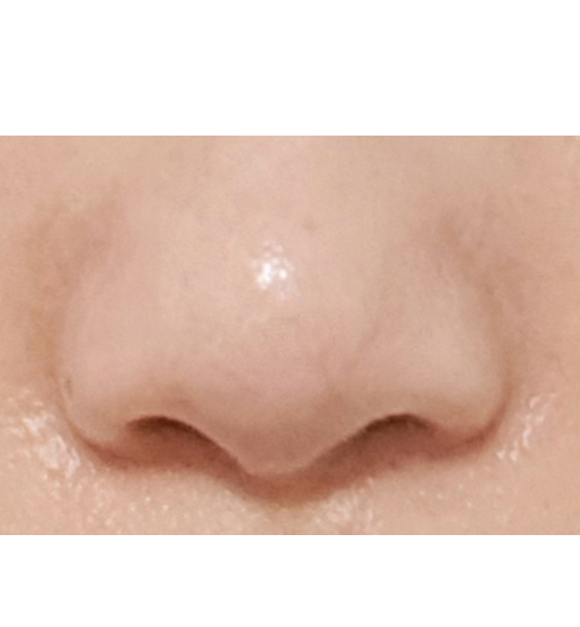 콧구멍 짝짝이 교정 굿굿 ㅎㅎ