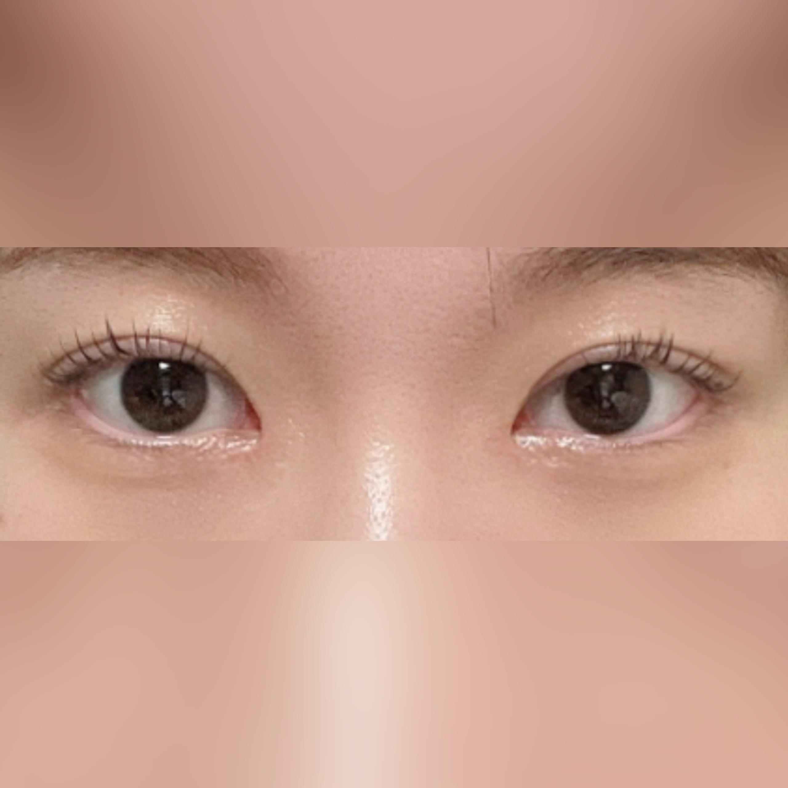 대만족스러운 눈성형 후기!!