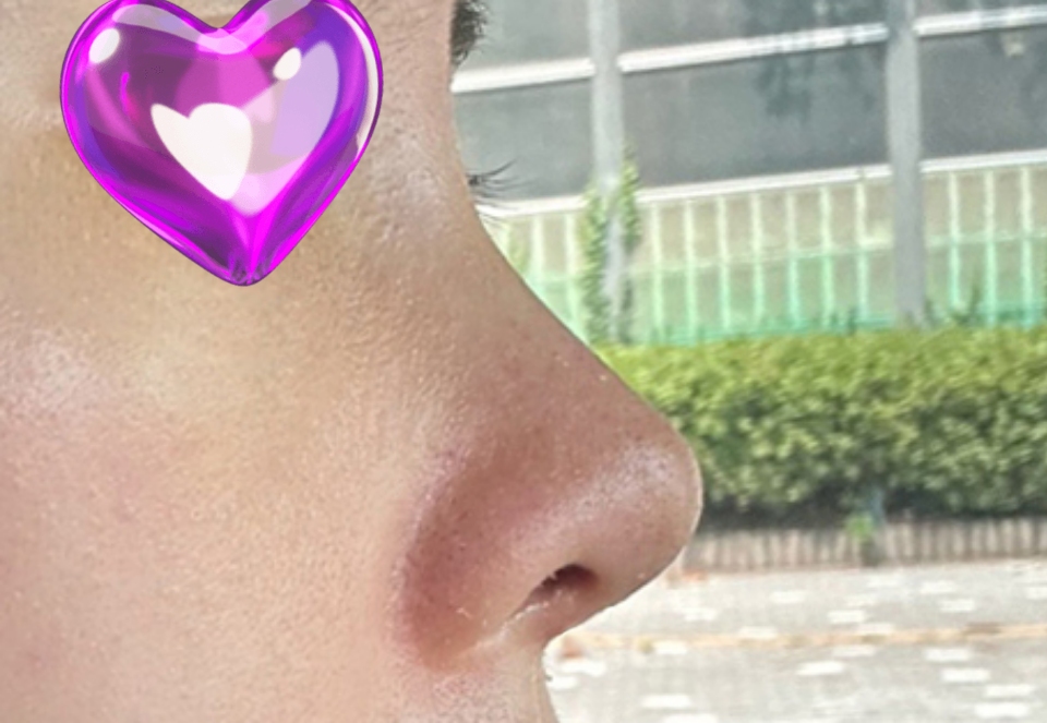 무보형물 코재수술한지 3개월지났어요:)