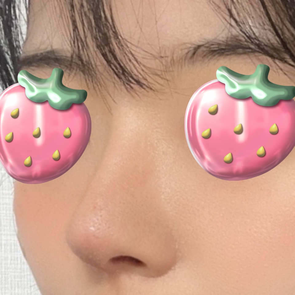 눈 ,코수술 6개월차 후기 입니다!