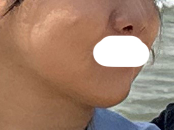 리포사운드 이중턱제거, 실리프팅 후기입니닷