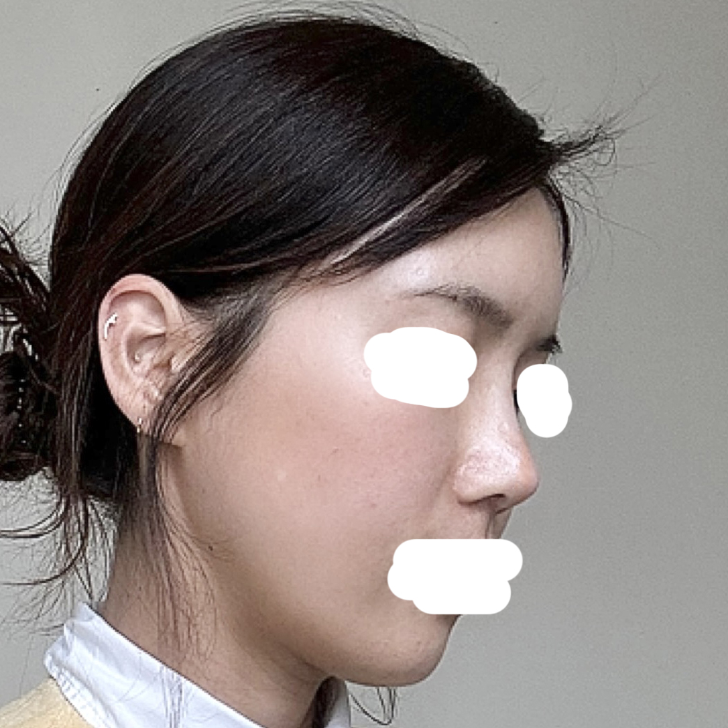 코, 지방이식 수술 후 인생 2막 시작 ^^