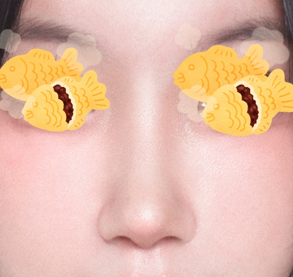 눈,코수술받은지 4개월넘어가네욥