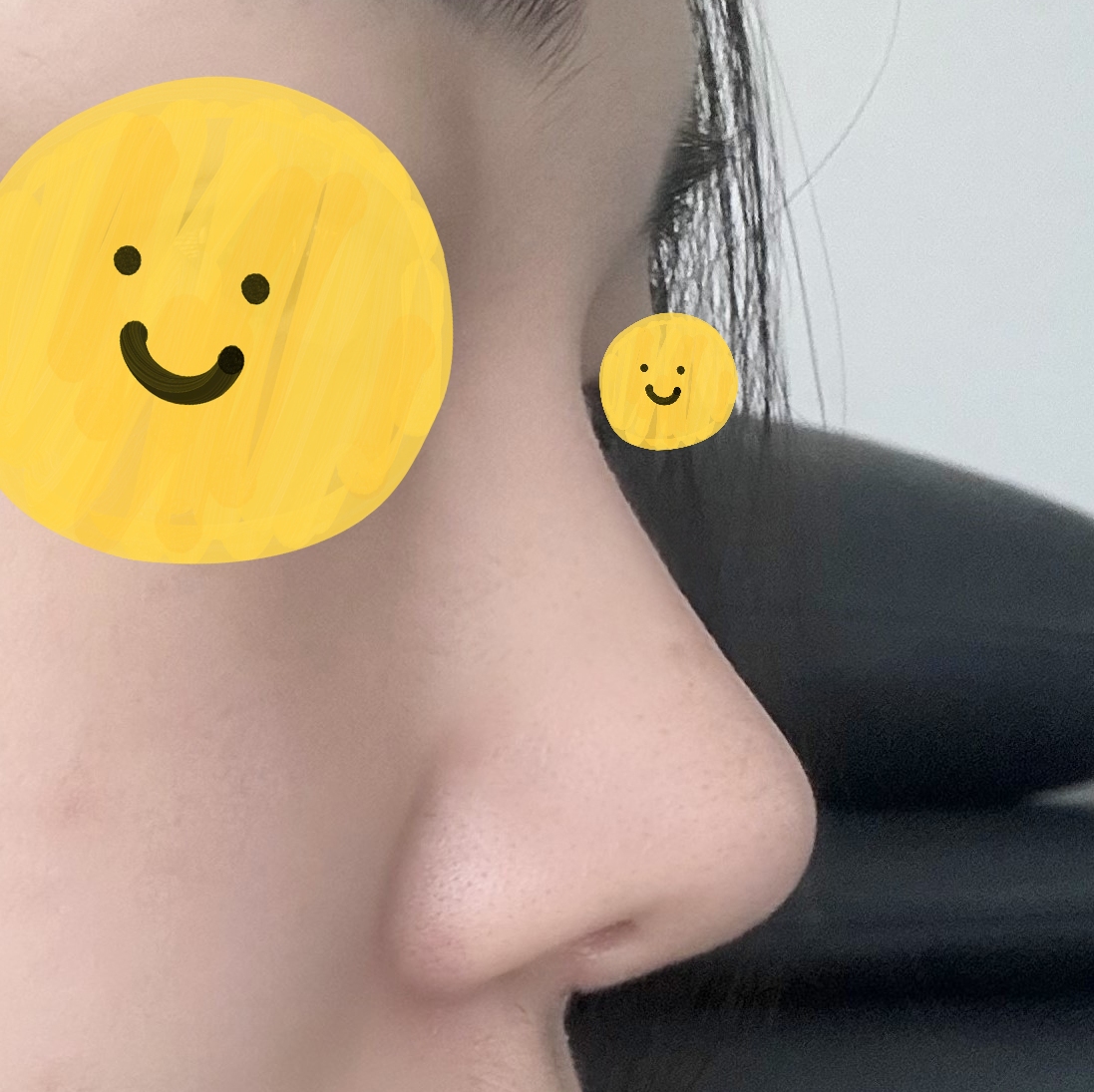 코수술은 바이브에서 !