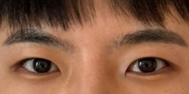 만족스러운 수술 입니다 ㅎㅎ