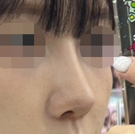 자가늑연골로 코재했어용