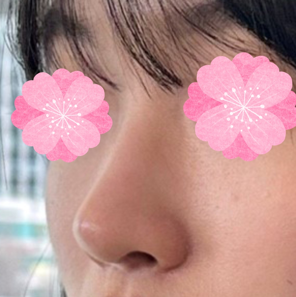 자연스러운 코는 역시 유영문 원장님 !