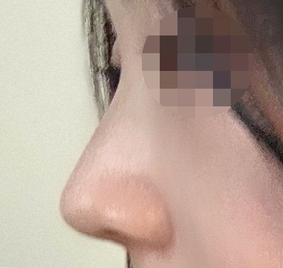 매부리, 긴코 개선돼써용~