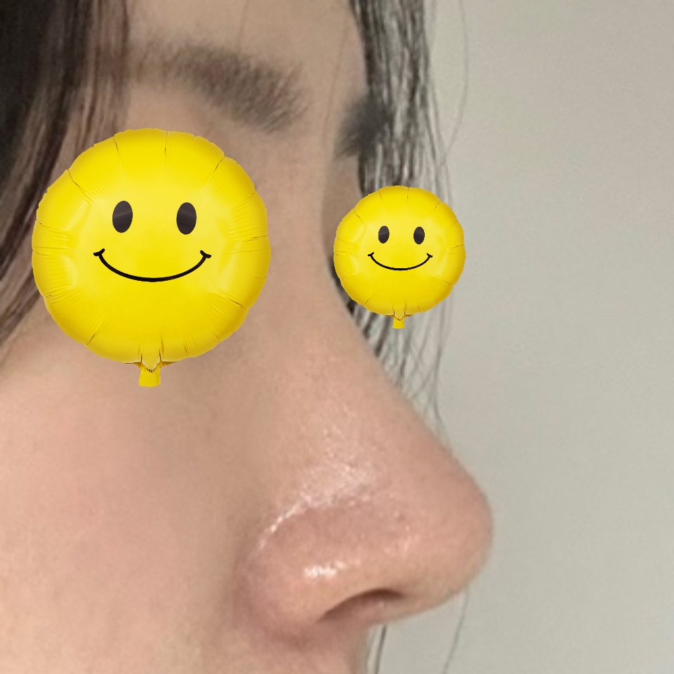 코수술 6개월차 후기 입니다 ~~!