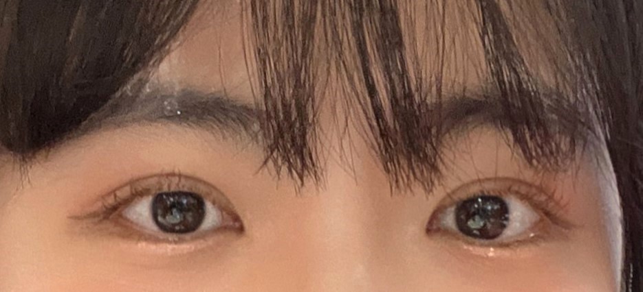 안검하수 개선됐어요!