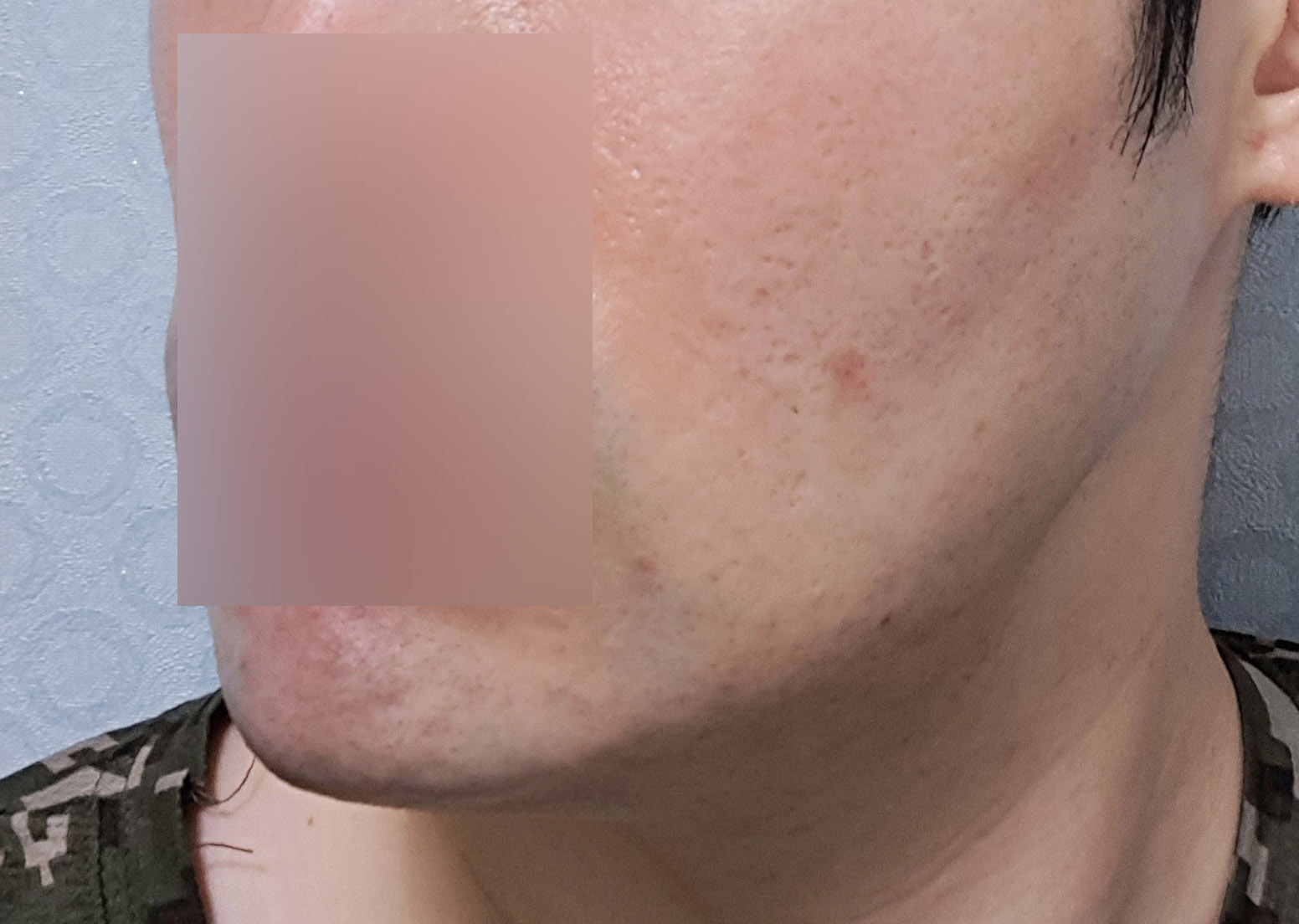 이중턱 지방흡입 후 턱선이 생겼어요