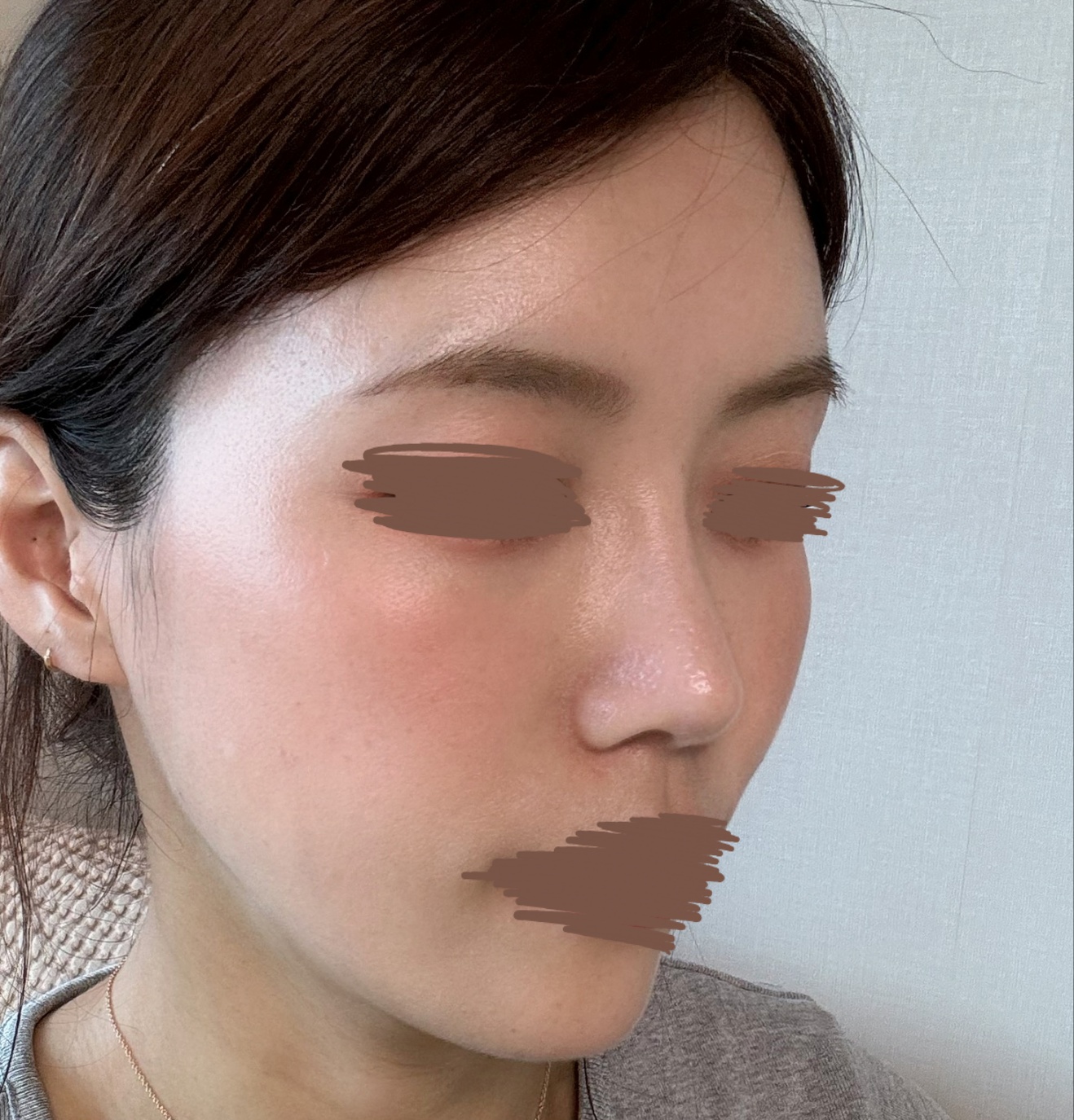 진작 수술할걸 그랬네요ㅎㅎ