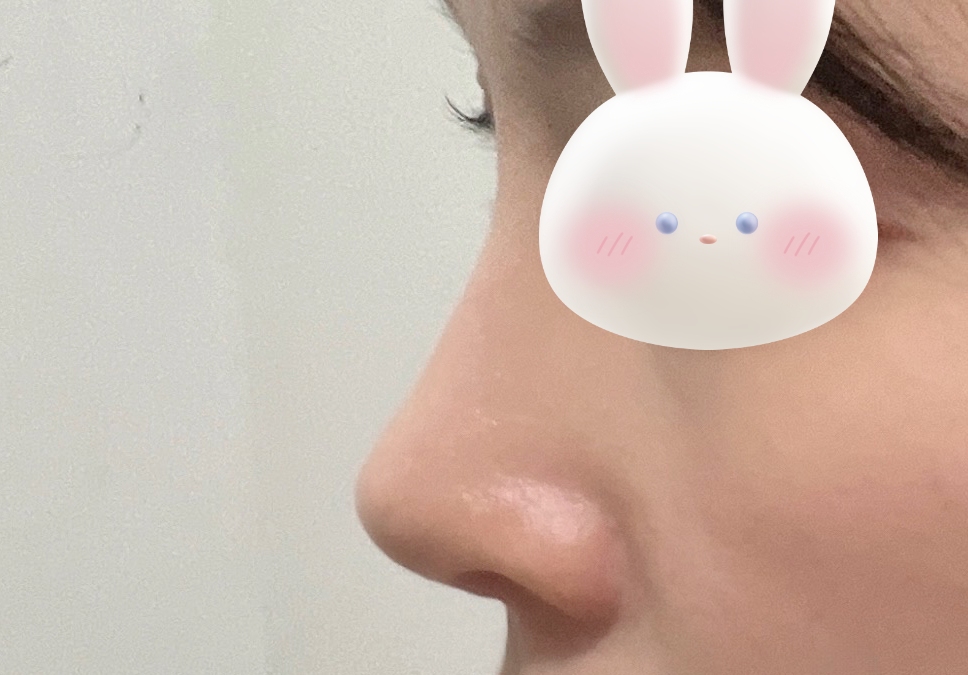 긴코+화살코성형후기!!