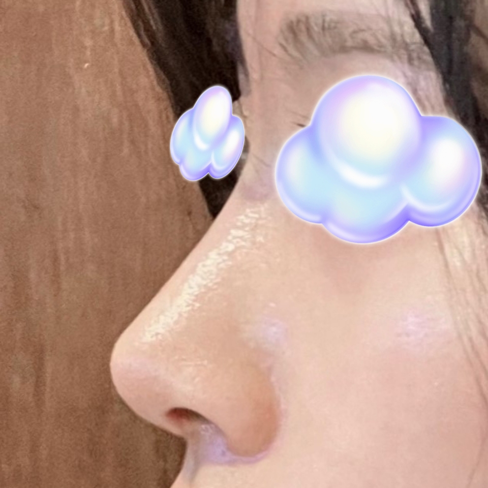 코수술 만족스러워요 감사합니다 원장님 !