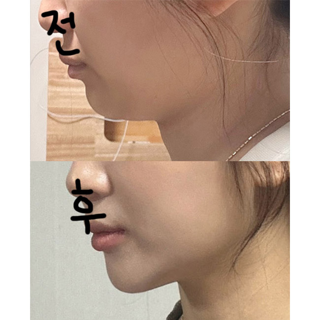 수술전후측면1.jpg
